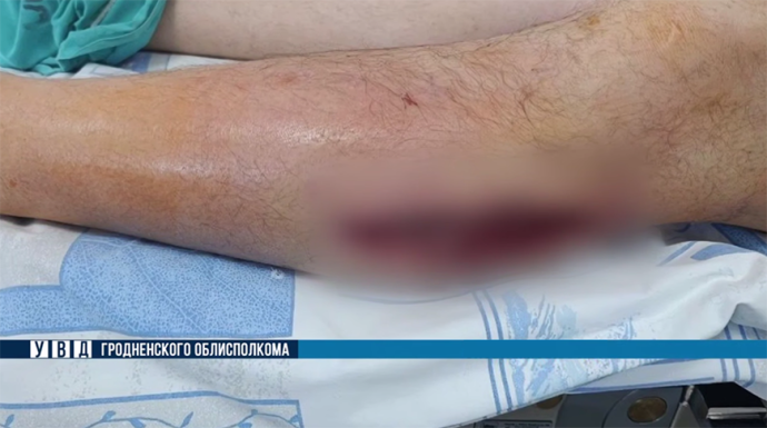 Житель Гродненской области получил огнестрельные ранения в Польше, его экстренно госпитализировали 0